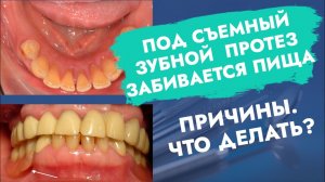 Под съемный зубной протез забивается пища. Причины. Что делать?