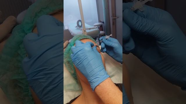 Ботокс межбровье смотреть онлайн