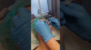 Ботокс межбровье