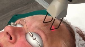 DEKA Smartxide Laser Cold Peel Bristol