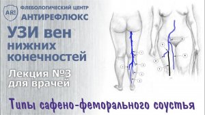 УЗИ вен нижних конечностей - конфигурация СФС