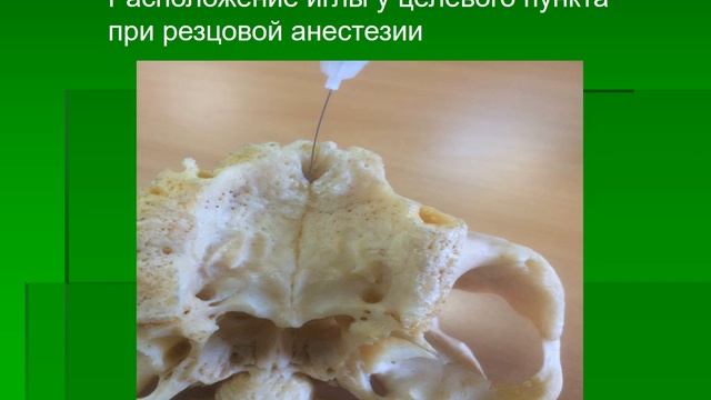 Способы местной анестезии на верхней и нижней челюсти