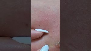 чистка прыщей, чистка чёрных точек, давлю угри