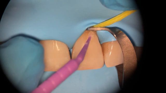 Прямая реставрация . Пришеечный кариес. Direct restoration. PART1 смотреть онлайн