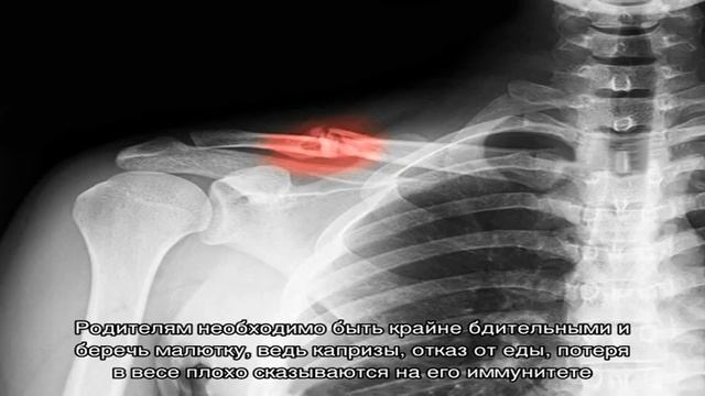 Как выглядит ключица после перелома Что делать при переломах ключицы разных видов? Лечение перелома ключицы с помощь