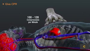 При оказании помощи пострадавшему от внезапной остановки сердца не все #АВД одинаковы