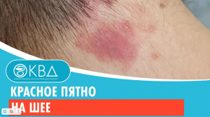 ? Красное пятно на шее. Клинический случай №358