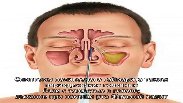 Полипы в гайморовой пазухе – симптомы и лечение