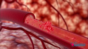 Инсульт. Новый метод лечения. Здоровье. Фрагмент выпуска от 21.05.2017