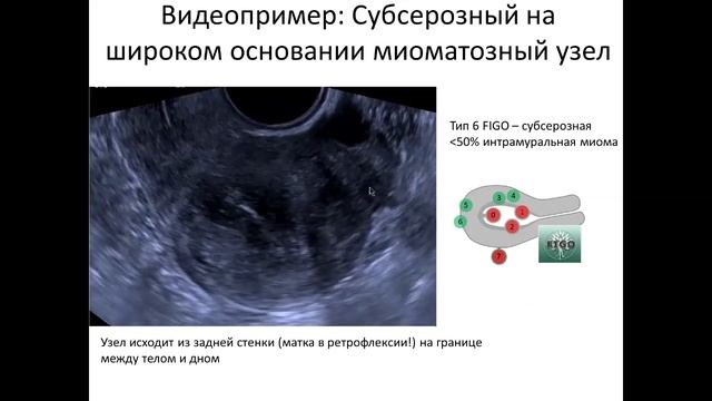 Типы миомы матки по figo. Миома матки Figo. Классификация миоматозных узлов. Классификация миом матки по УЗИ. Классификация по Фиго миомы матки.