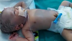 Перинатальный асфиксия