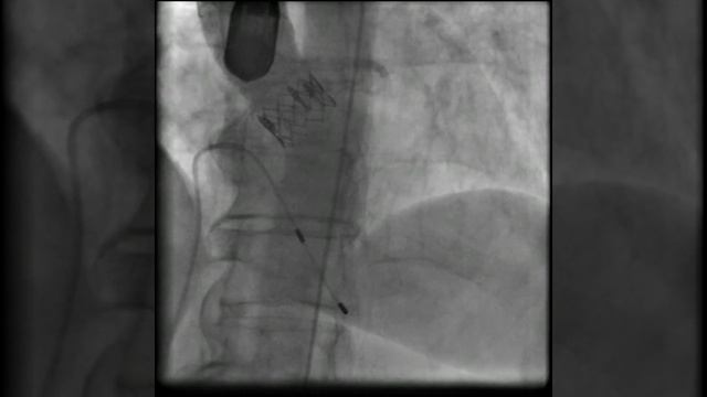 Грудная аортография после имплантации аортального клапана (конечный результат) смотреть онлайн