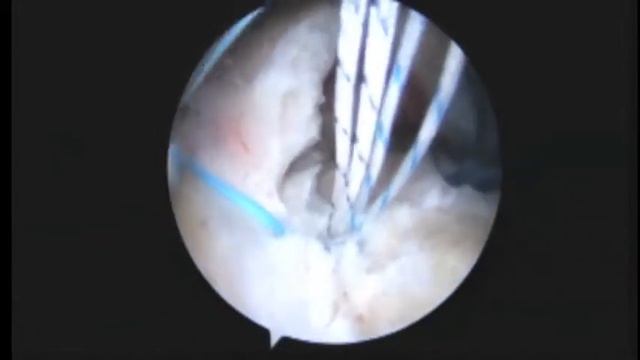 DS R arthroscopic rotator cuff repair of large tear and biceps tenodesis 1 8 15