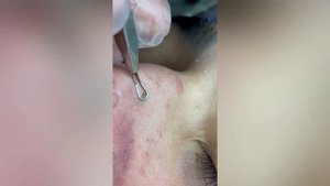 trash compilation | squeezing pus | подборка выдавливание гноя  и черных точек