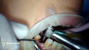 ОДНОМОМЕНТНАЯ ИМПЛАНТАЦИЯ В ЛУНКУ 24 ЗУБА \ IMMEDIATE IMPLANT PLACEMENT