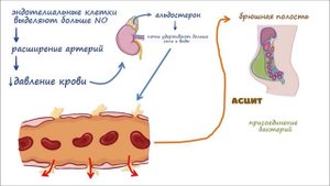 Портальная Гипертензия