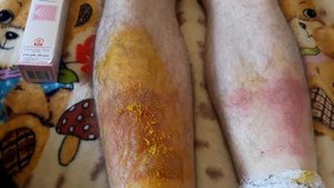 Муж получил ожог борщевиком. Часть 2. День 4й.