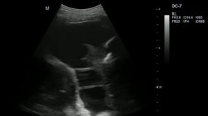 Плевральная полость, шварты