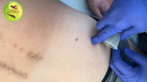 Гирудотерапия при грыже позвоночника