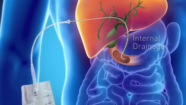 Biliary Drain – смотреть онлайн видео от Дренаж с мастерством в хорошем ...