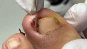 Супер ноготь на пальце ноги   Никогда не позволяй себе становиться так плохо