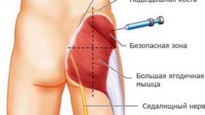 Как правильно поставить укол/  Сидалишный нерв   /Инъекция ( 90, 45 , 25 , 15 -10 )  Dr. Mathieu