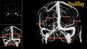 МРТ-анатомия магистральных венозных синусов головного мозга