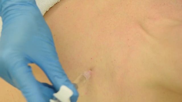 Мезотерапия области декольте / Decollete mesotherapy