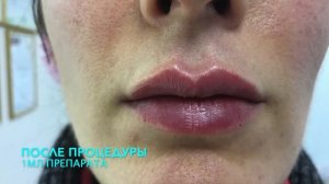 Контурная пластика губ (Juvederm VOLBELLA)