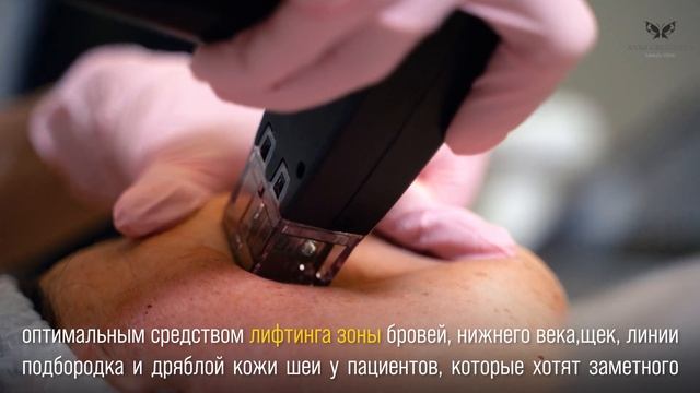 Игольчатый RF-лифтинг Morpheus 8 смотреть онлайн