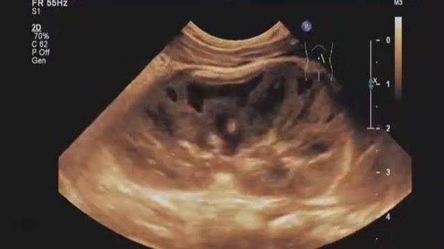 Инфаркт почки смотреть онлайн