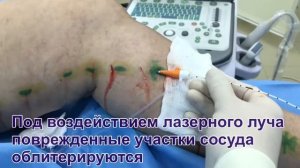 ЭВЛК. Эндовазальная лазерная коагуляция вен
