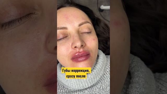 Увеличение губ сразу после #губы смотреть онлайн