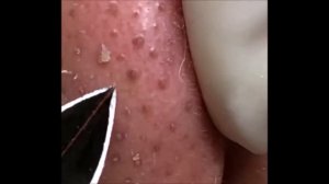 Relaxing Acne Treatment Acnes Treatment  132