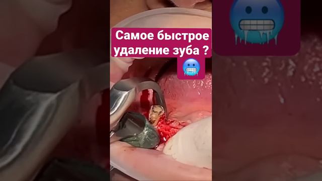 Самое быстрое удаление зуба? 🥶🤬#шортс #стоматология #москва #хирург 🙈