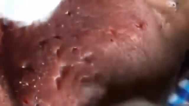 КОВЫРЯЕТ КРОВАВЫЕ ПРЫЩИ НА НОСУ И ЩЕКАХ