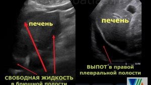 Отличие асцита от выпота в плевральной полости