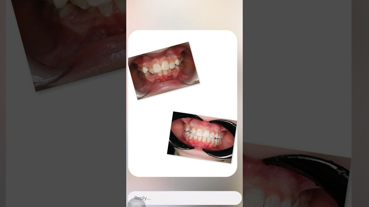 ИСПРАВЛЕНИЕ ПРИКУСА  ☎️  +7(495)108-11-49 #допосле #лечениезубов #лечениенабрекетах #элайнеры