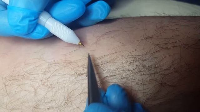 Электроэпиляция Уфа