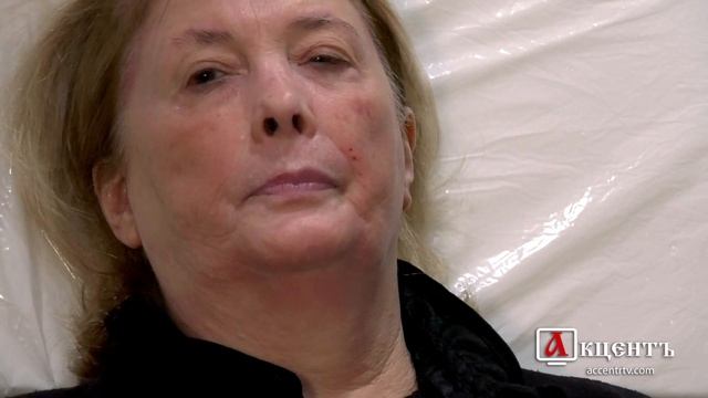 Филлеры для лица. Обзор и применение препаратов гиалуроновой кислоты и гидроксиапатита кальция.