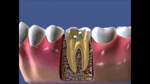 Уроки стоматологии Как правильно пломбировать корневые каналы в зубе