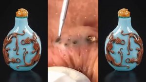 Удаление черных точек, полное видео от доктора Nana, Blackhead Removal часть 18