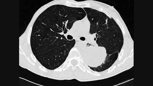 Рак легкого и эмфизема. КТ диагностика смотреть онлайн