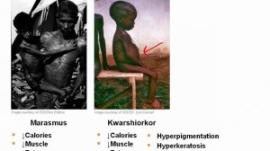 Protein-Energy Malnutrition.mp4