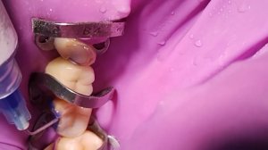 Травление поверхности зуба 37.Ортофосфорная кислота.