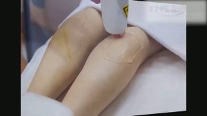 Лазерная эпиляция диодным лазером