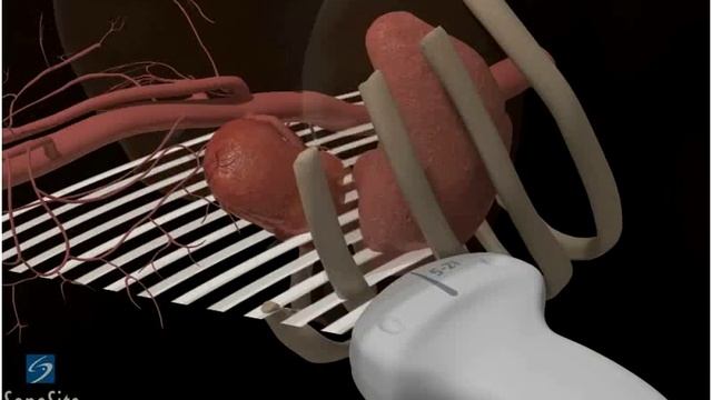 3D-пособие: Ультразвуковое исследование левой почки -- ультразвуковая система SonoSite