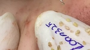 Addictive when watching blackheads pop up (325) | Loan Nguyen