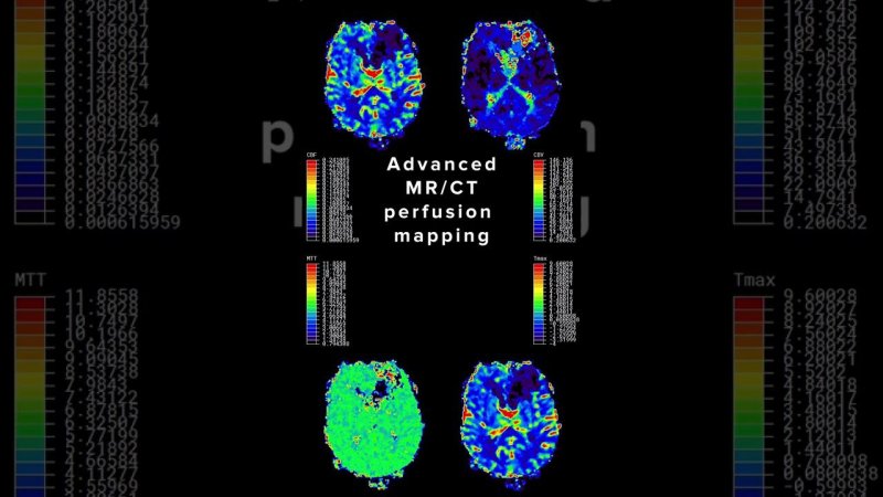 Brain perfusion mapping