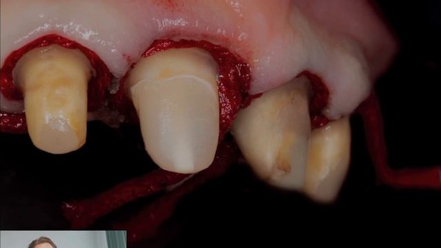 Создаем красивую улыбку за небольшие деньги . Коронки на зубы и циркония и протез на верхнюю челюст смотреть онлайн